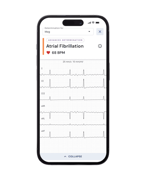 KardiaCare reading with Afib detection